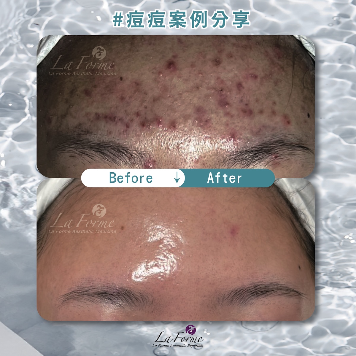 BA痘痘分享官網-01_0