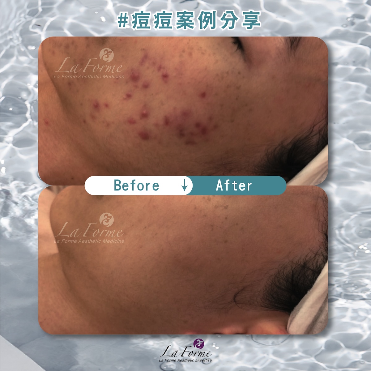 BA痘痘分享官網-02_0