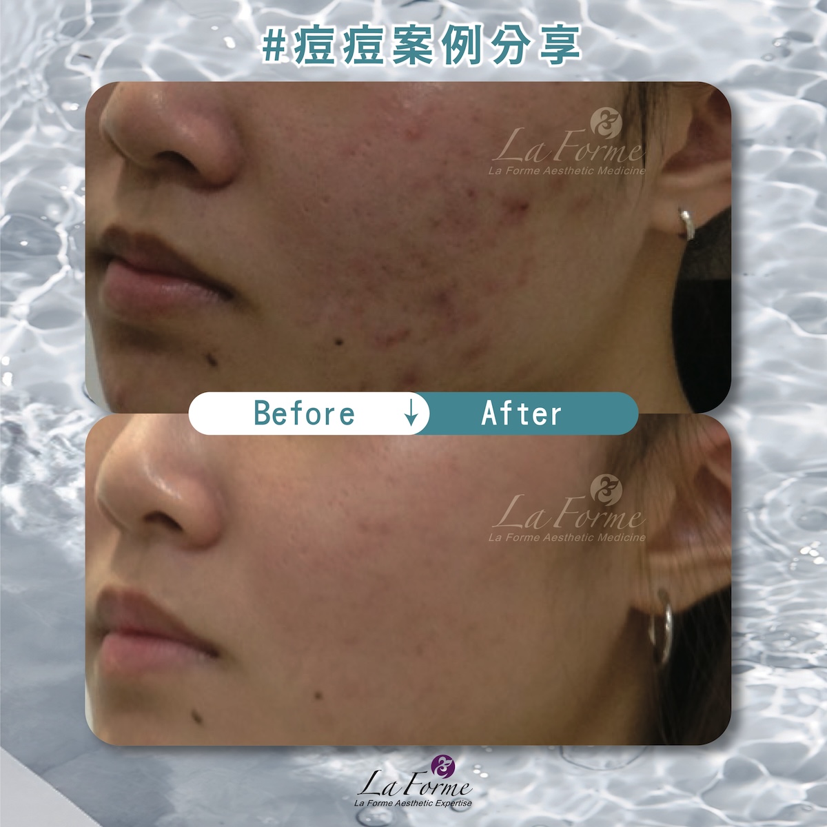 BA痘痘分享官網-03_0